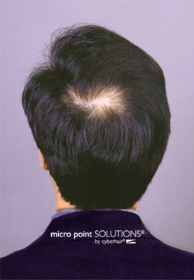 Hair Loss Solution - Before & After Color