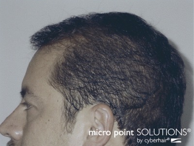 Read more: Men's Micropoint Hair Replacement Solutions