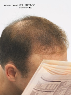 Read more: Men's Hair Loss Solutions for Portland Area Men