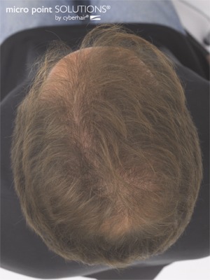 Click to view more about Mens Hair Replacement